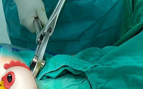 差點成公公！男用「情趣環」竟卡住  醫動鋼針剪搶救「象拔蚌」