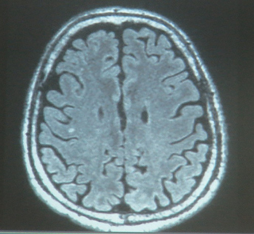 公布扁MRI  陳順勝：修護神經髓鞘可治癒