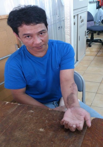 走不完的99哩異鄉路（一）差點沒了左手