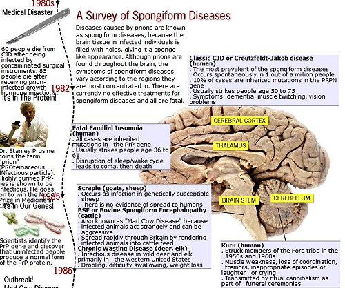 大腦海綿化 英每2千人中1人帶庫賈氏蛋白