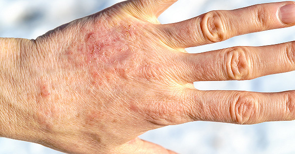 乾癬反覆發作好難纏中醫內外調理多管齊下 生活 新頭殼newtalk