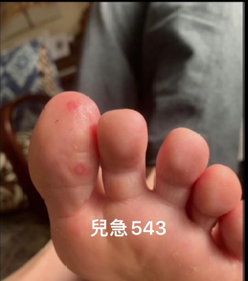 美國兒童皮膚科醫師表示「COVID腳趾」這種類似水痘或麻疹的病變，可能是無症狀兒童患者感染的跡象。   圖：翻攝自來講兒科急診的543-吳昌騰醫師 粉絲專頁