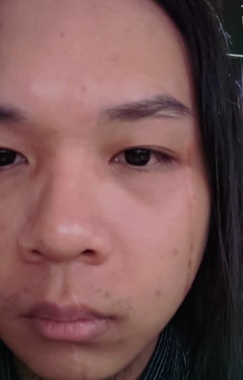  「長髮哥」於去年中捷隨機攻擊事件中挺身而出與嫌犯對峙，因而留下的傷疤。 圖：翻攝自 Threads 帳號 @hsu__ray 