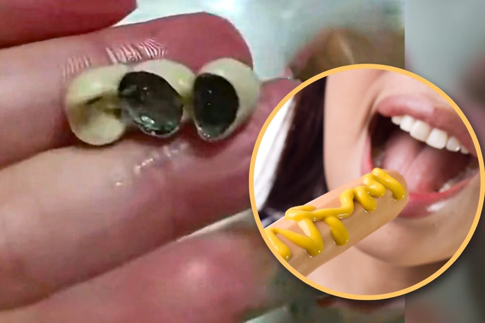 中國東北部吉林省的一名女性表示,她所購買的幼兒用的香腸中發現了三顆並排的人工牙齒。   圖:翻攝南華早報