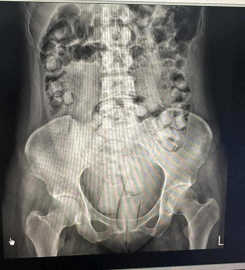 海巡署偵防分署台中查緝隊9月在高雄小港機場查獲2名泰國籍女子，吞食海洛英毒品以人體夾帶方式走私。（民眾提供）中央社記者趙麗妍傳真　114年12月11日   