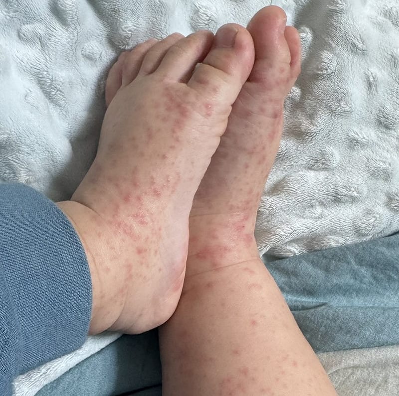 1歲4個月大的男嬰雙腿佈滿水泡，令大人看了心疼。&nbsp;&nbsp;&nbsp;圖：家長提供