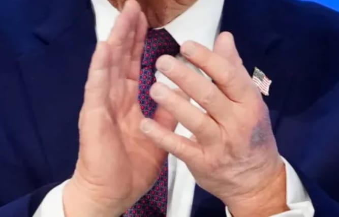 美國總統川普又被發現手背大面瘀青。&nbsp;&nbsp;&nbsp;圖 : 翻攝自環球網