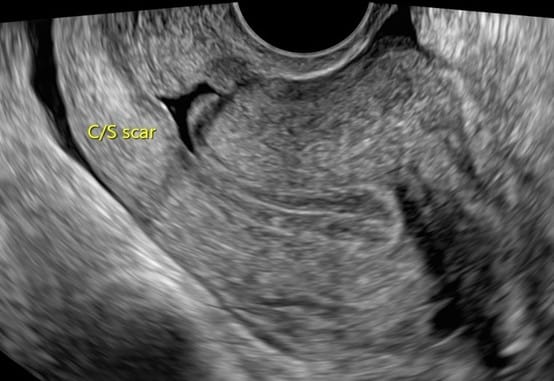 子宮下段缺損積血的超音波畫面。&nbsp;&nbsp;&nbsp;圖：陳碧華醫師/提供