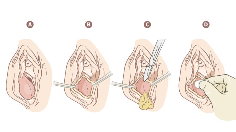 搭配膠原蛋白基質粉(D)放在巴氏腺囊腫切開引流造口手術示意圖。&nbsp;&nbsp;&nbsp;圖：陳碧華醫師/提供