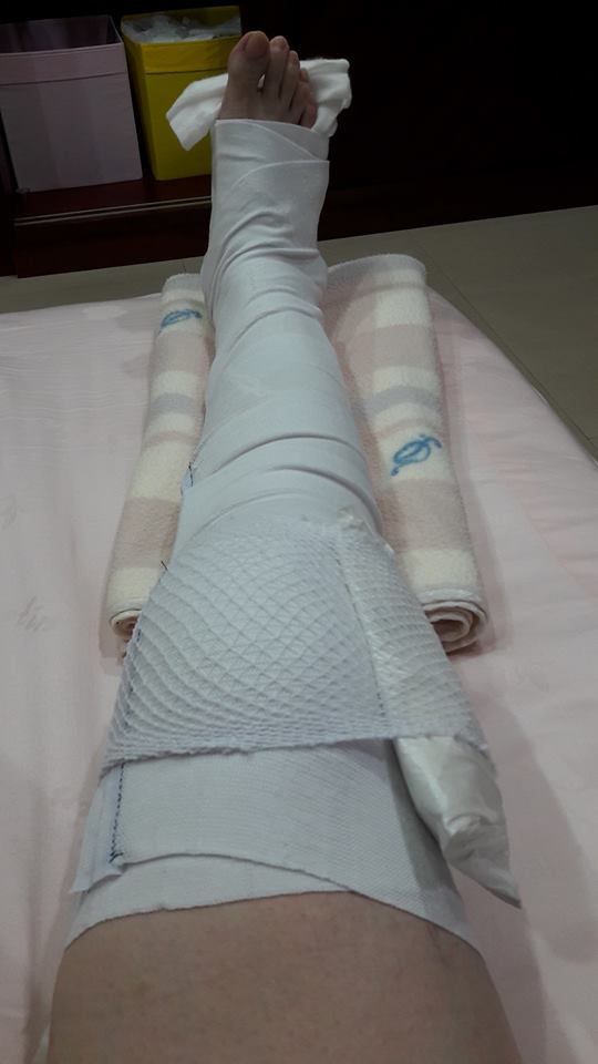 高市議員林瑩蓉凌晨遭飛車撞，造成右膝蓋骨折。   翻攝林瑩蓉臉書