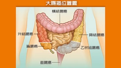 大腸癌位置圖。   圖：取自全民健康基金會網站