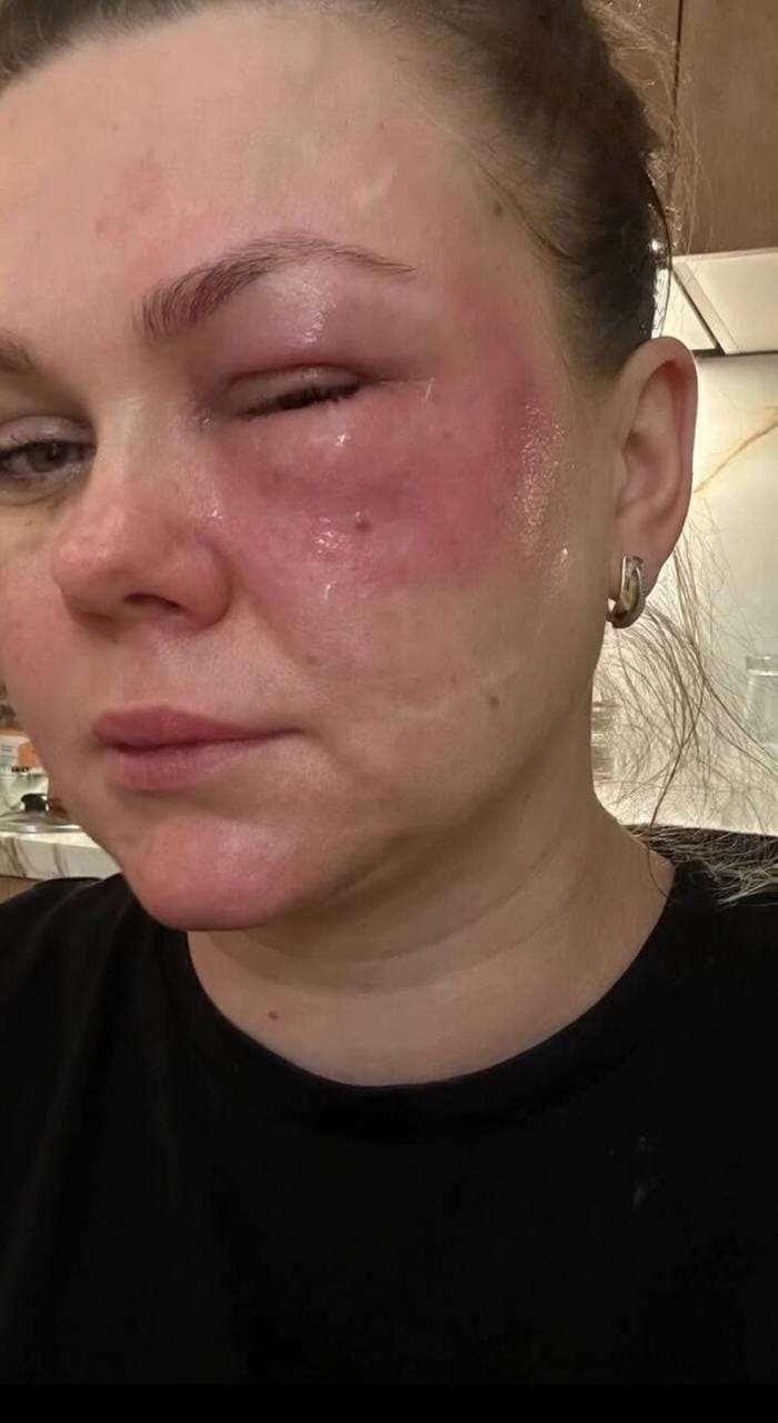 一名俄羅斯女子在注射「鮭魚精液」後產生了不良反應。&nbsp;&nbsp;&nbsp;圖:翻攝自X帳號@nexta_tv