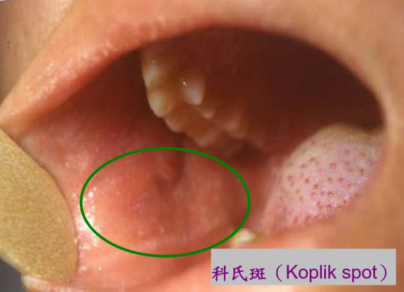 麻疹患者口腔內會出現斑點。   圖 : 台中市衛生局/提供