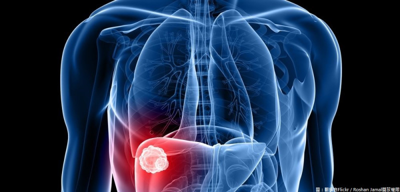 國家衛生研究院研究發現，非病毒性肝癌最重要的三個風險因子分別為脂肪肝、糖尿病史以及三酸甘油脂過高。   圖：翻攝自Flickr／Roshan Jamal開放權限