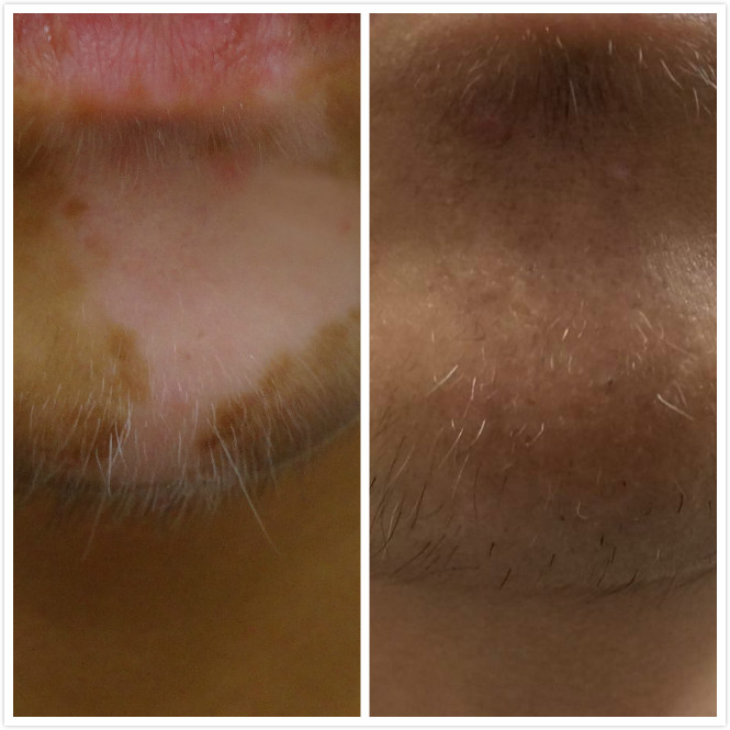左邊為治療前，右邊為經治療後長出黑色鬍鬚。   圖 : 光田醫院/提供