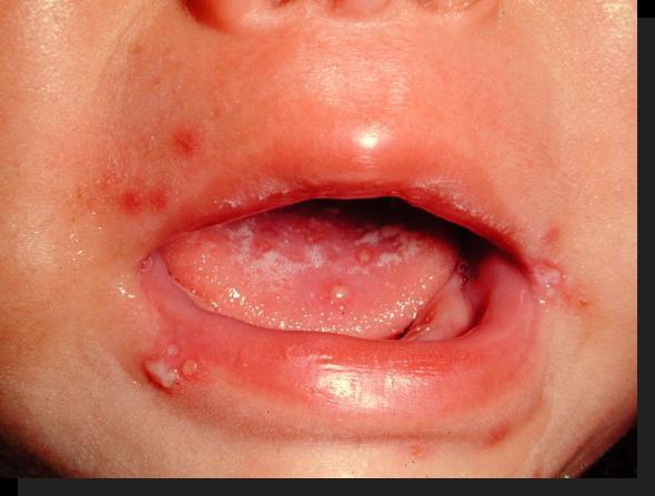 腸病毒常會造成新生兒口腔內起水泡。   圖 : 翻攝自sunshinehouse99.pixnet