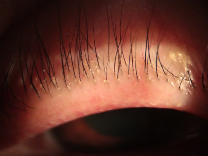 睫毛根部包覆乾性的白色屑屑，放在顯微鏡下查看，竟發現毛囊蠕形蟎蟲，若不治療可能造成毛囊發炎甚至乾眼症。   圖：台北慈濟醫院提供