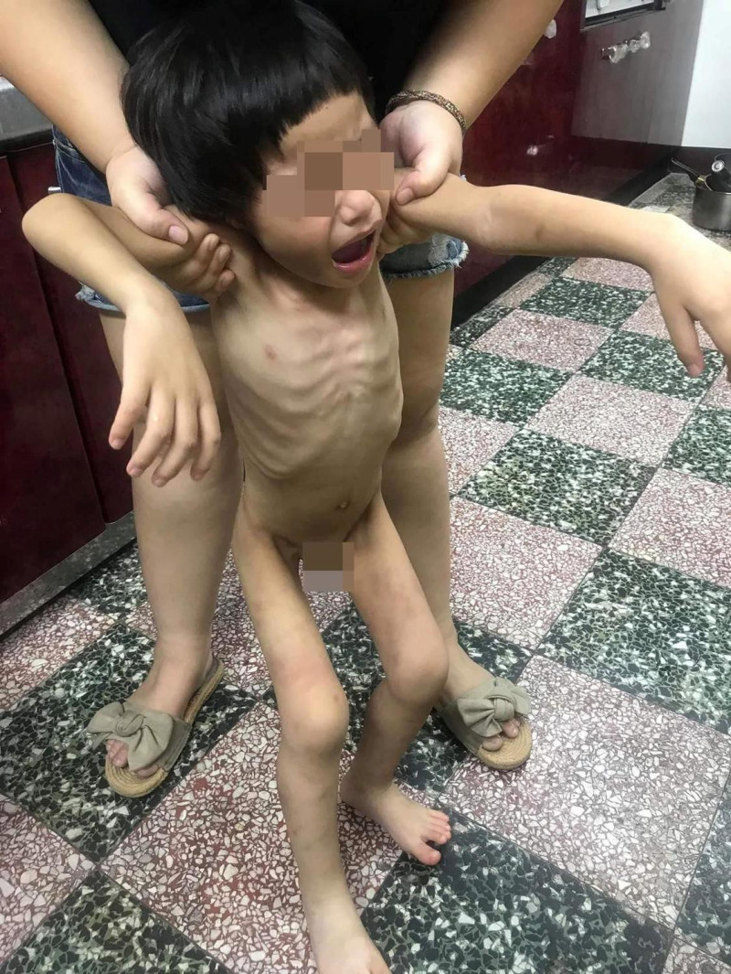 新竹受虐男童，被發現時已經瘦成皮包骨，身上還有多處瘀傷。   圖：翻攝自爆料公社
