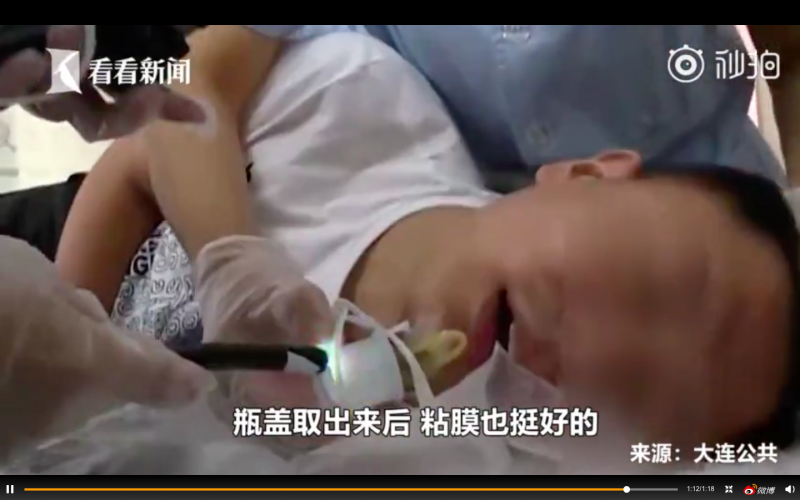 男喝酒誤吞瓶蓋。   圖／翻攝自看看新聞