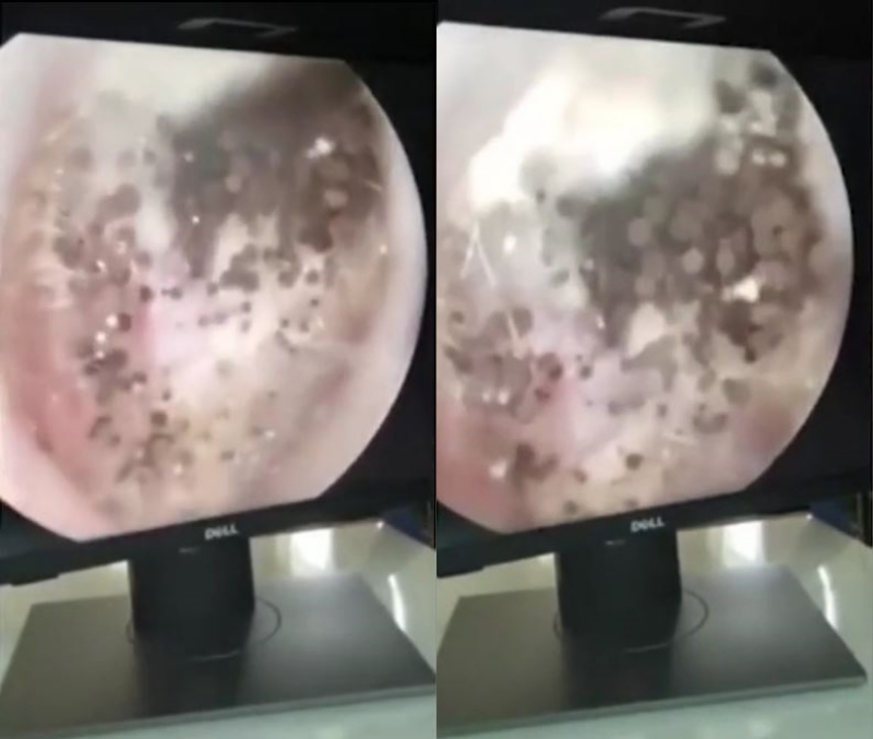 越南一名男子最近出現了耳朵又痛又癢的症狀，去醫院檢查後，醫生發現男子的耳內竟然變成了一片黑壓壓的「蘑菇森林」，令人嘆為觀止。   