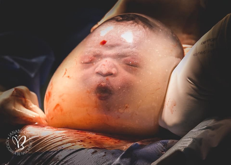 男嬰被羊膜囊包覆著出生，看起來宛如絲襪套頭。   圖／翻攝自 Monyck Valasco 的臉書