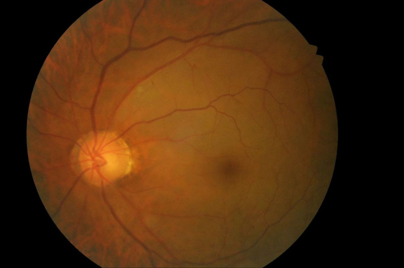 動脈阻塞型眼底中風，因黃斑部區缺血致眼球明顯變白無血色。   圖：安南醫院／提供