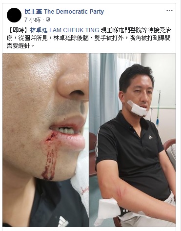 香港立法會議員林卓廷也遭到白衫軍打到濺血，縫了好幾針。   圖：翻攝自香港民主黨臉書