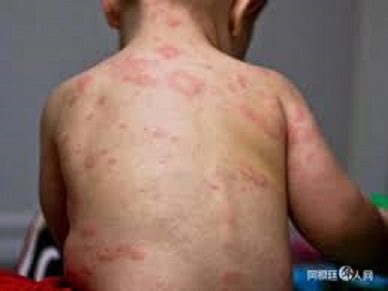 阿根廷爆發近20年來最嚴重麻疹疫情，已有61起確定病例。   圖 : 翻攝自argcchina.com