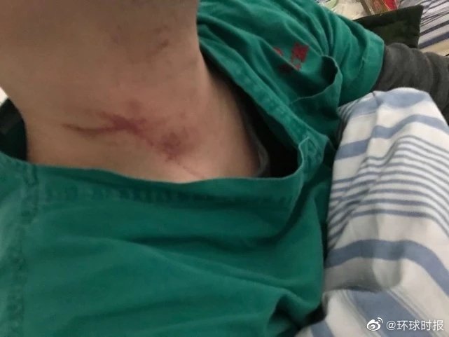 根據北京青年報報導，武漢市第四醫院有兩名醫生於29日時，遭一名新型冠狀病毒肺炎患者家屬毆打。   圖：環球時報微博