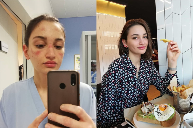 義大利急診護理師 Alessia Bonari 曬出自己因為戴護目鏡滿臉勒痕的照片。   合成圖／翻攝 @alessiabonari_ IG