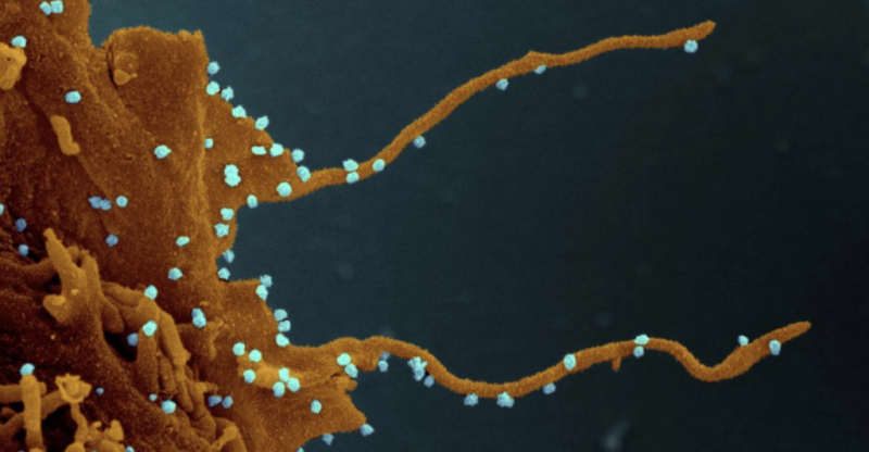 由美國國家衛生院（NIH）的（Elizabeth Fischer）費雪博士拍攝，受武漢肺炎病毒感染的人體細胞長出「絲狀偽足」。   翻攝自網上