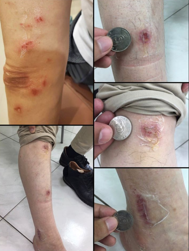 民進黨立委郭國文今(3)日放上相片，有一個傷口幾乎要和10元硬幣一樣等大。   圖：翻攝自郭國文臉書