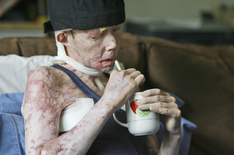 在2007年塔雷頓的丈夫用強鹼溶液攻擊她，導致臉部溶解、身體約80%燒傷。   圖 : 達志影像/美聯社