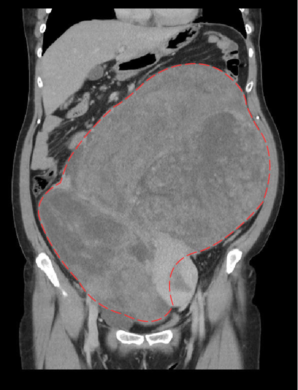 電腦斷層掃描可見患者腹部內的巨大子宮肌瘤。   光田綜合醫院/提供