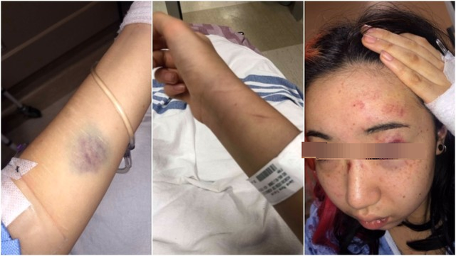王莫娜展示遭到警員暴力後，身上的多處傷痕。   圖 : 翻攝自環球網