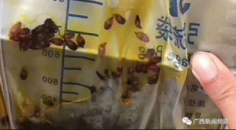 中國男子吃淡水生魚片32年，大量「肝吸蟲」藏於膽管中，多數體型如同瓜子一般大小，讓醫師看完也相當驚訝。   圖：翻攝自網路