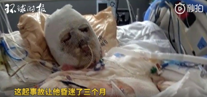 美國紐澤西州的迪梅奧，遭逢車禍後全身有八成面積三度燙傷，醫師團隊為他進行換臉與雙手手術。   圖 : 翻攝自環球時報