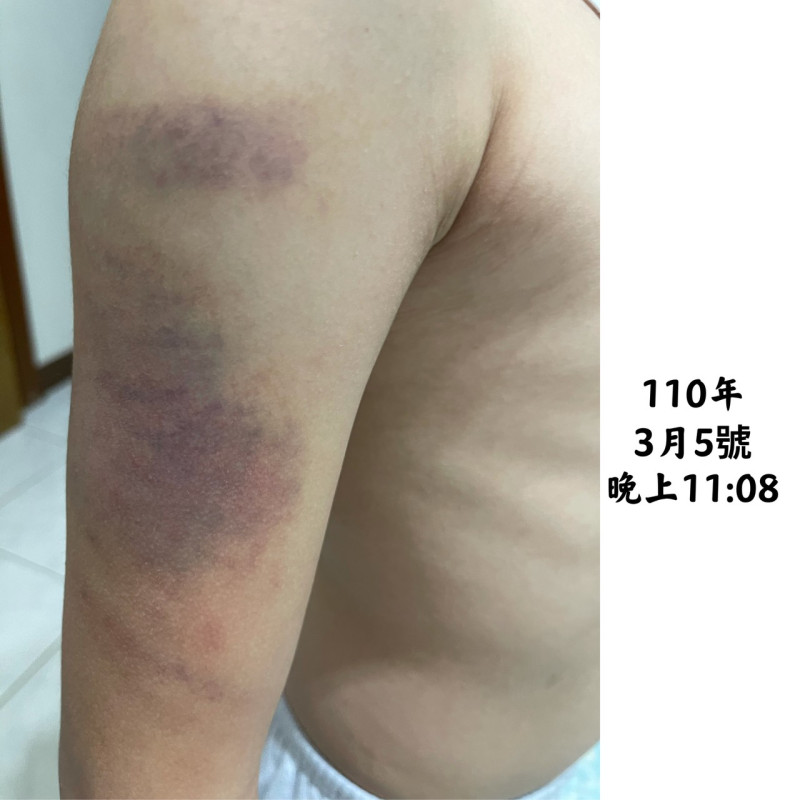 台中市10歲男童在補習班遭女教師毒打成傷。   市議員鄭功進/提供