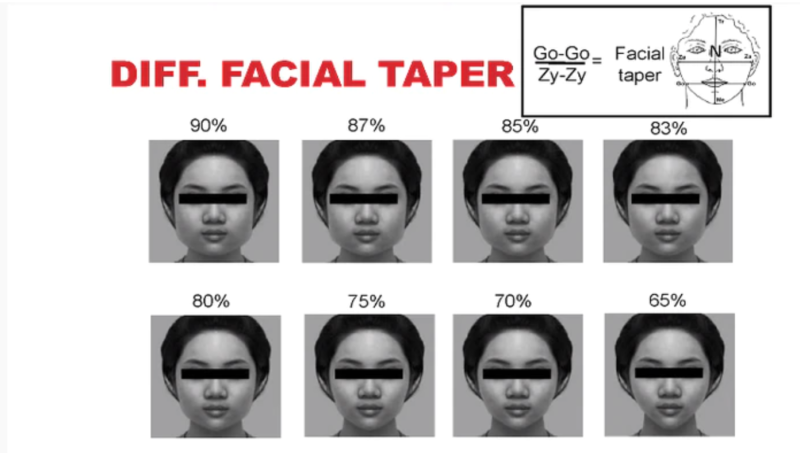 台灣最喜歡的瓜子臉在兩者之間，是「下頷骨角間距」的「顴骨間距」比例為75%，如果比例上升至83%，就會被認為是「國字臉」。   圖：陽明大學/提供