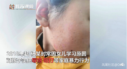 中國江蘇南通一名12歲女孩因未及時完成母親交代的作業，竟然遭到母親辱罵、毆打，甚至用燒熱的鐵鏟燙傷孩子的手部、面部，幾乎是虐待行為。   圖：翻攝自荔枝新聞