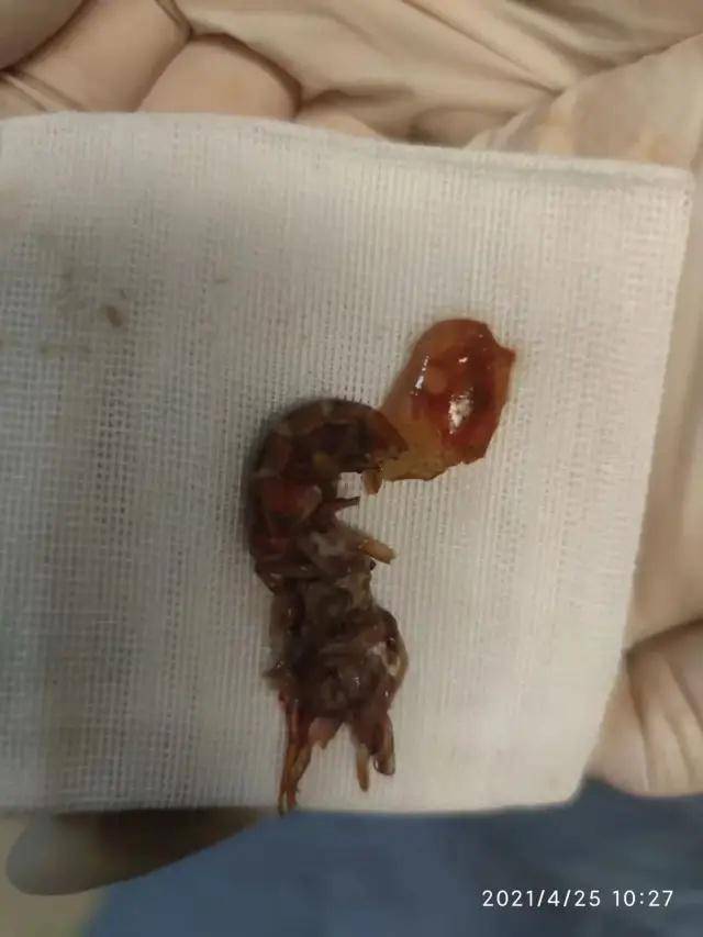中國浙江一名14歲少年把小龍蝦塞進肛門裡，無辜的小龍蝦被取出後則斷成兩節慘死。   圖：翻攝瀟湘晨報
