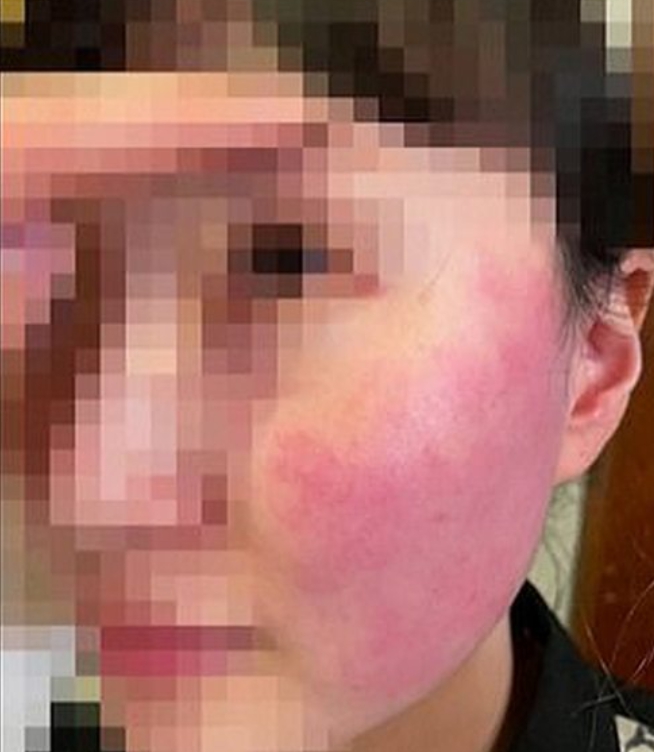韓國籍店員今年五月遭相雪秋打到面部紅腫，眼睛出血。   圖 : 翻攝自網路