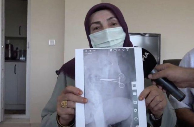 土耳其一名有7個孩子的母親，在開完腹部除皺手術後，感到疼痛難耐，竟發現一把手術剪刀遺留在她的肚子裡。   圖 : 翻攝自環球時報