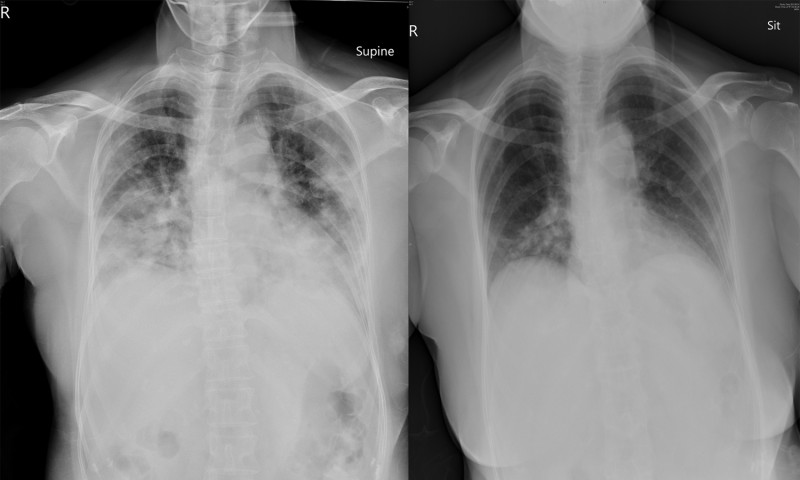 新冠肺炎重症患者入院時X光片可見雙側肺葉嚴重浸潤(左)，出院前可以看到浸潤狀況有很大程度改善(右)。   圖：嘉義基督教醫院/提供