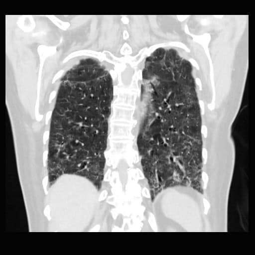蘇一峰醫師曝染疫重症患者的「肺纖維化」照片，表示該名病患無法脫離氧氣罩生活。   圖：翻攝自蘇一峰臉書