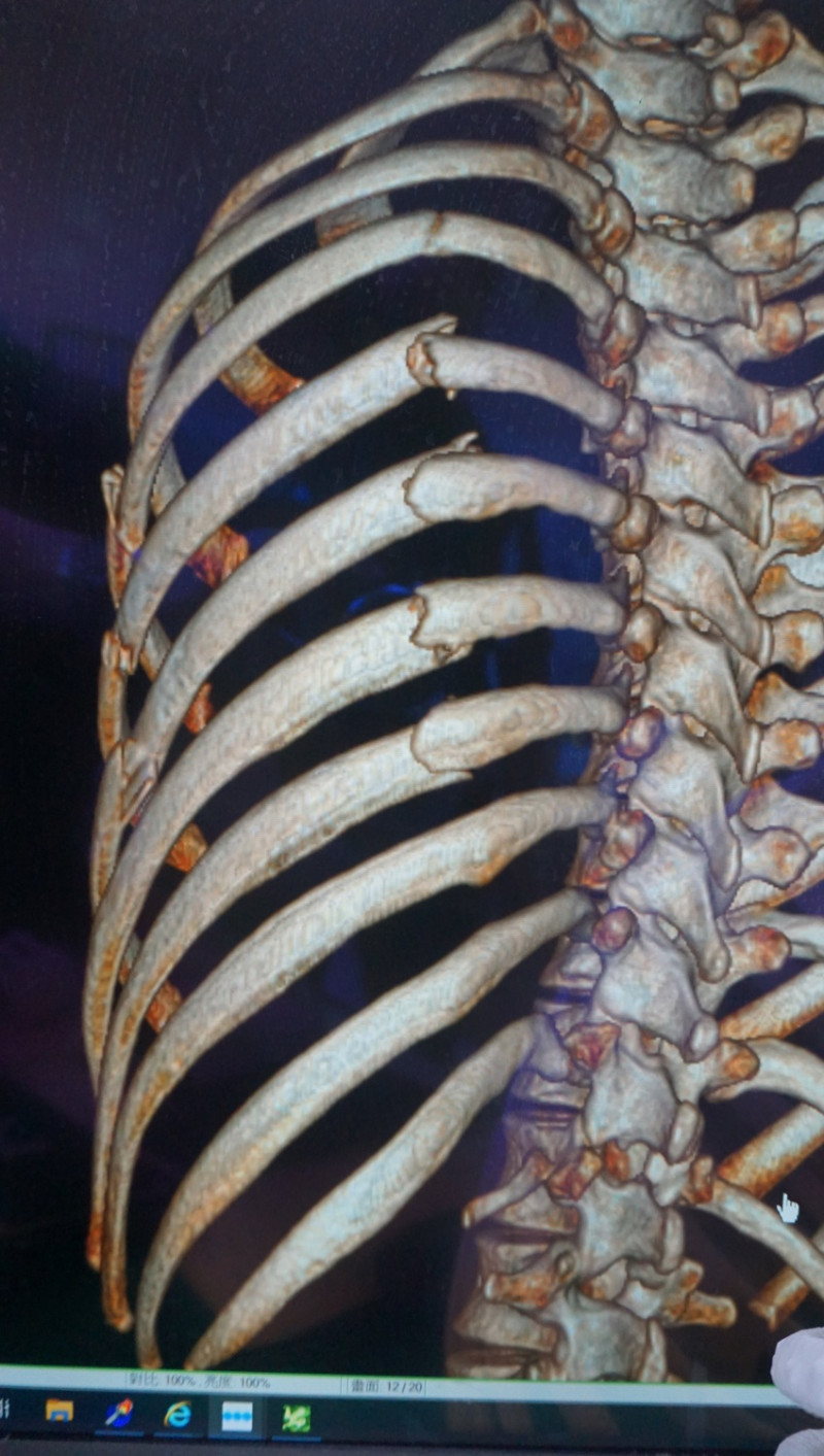國軍台中總醫院胸腔外科主任謝志明說，若肋骨骨折狀況是「連枷胸」，應採取積極治療方式。   謝志明/提供