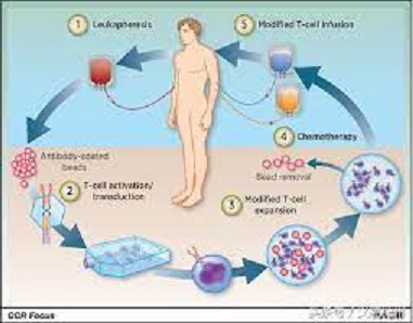 CAR-T 細胞療法，就是先從患者身上提取出 T 細胞，之後通過基因工程技術啟動 T 細胞，並裝上 CAR，把普通 T 細胞變身 CAR-T 細胞，再將改造後的 T 細胞回輸到患者體內，發揮殺傷癌細胞的作用。   圖 : 翻攝自頭條號