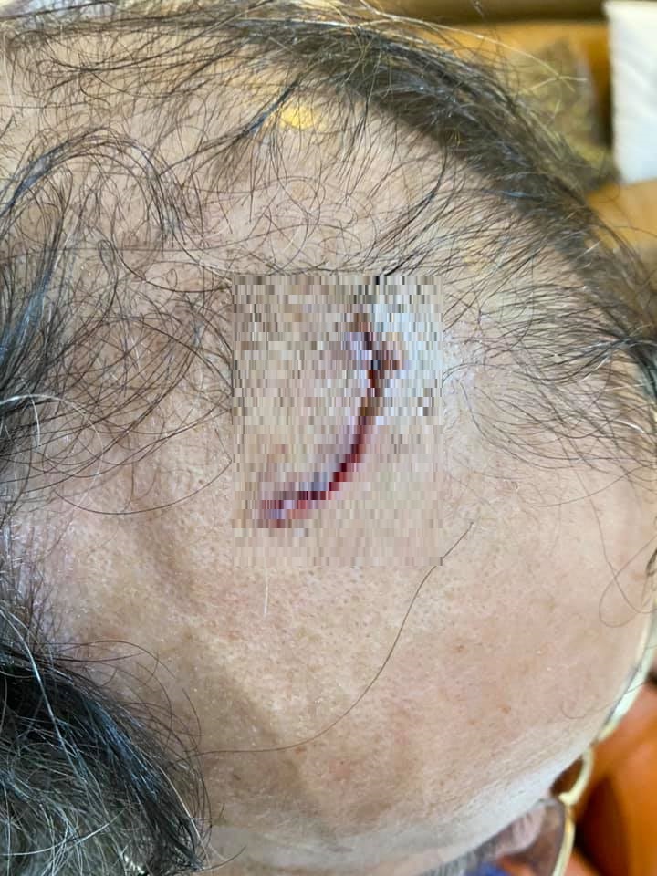 張景森PO出一張自己頭上的疤痕。   圖：擷取自張景森臉書