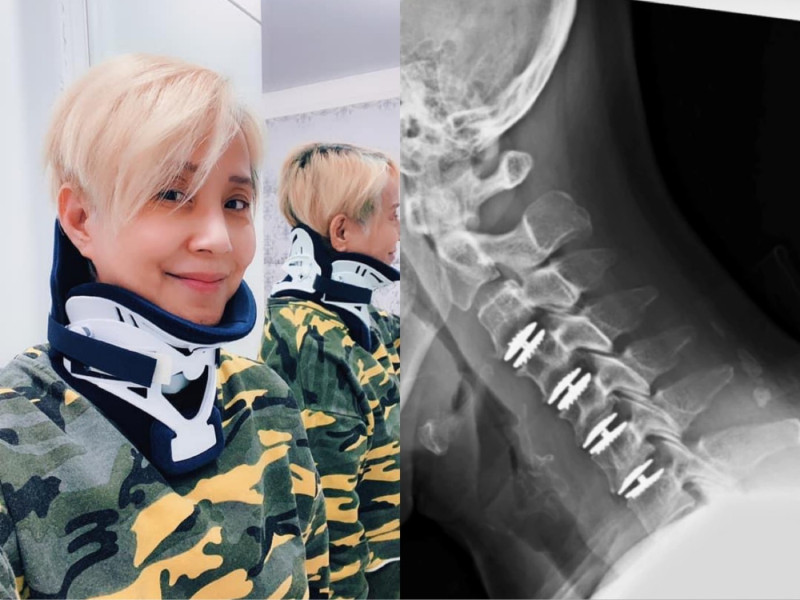 李明依在11月初自費110萬進行手術，換上了4個人工椎間盤。   圖：翻攝自臉書