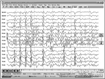 癲癇發作時的腦電圖表現。   圖：擷取自微博